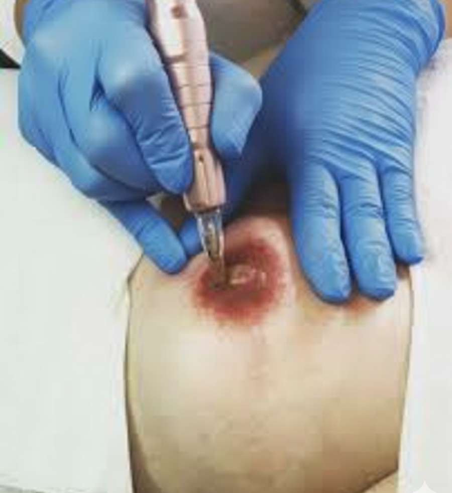 micropigmentación de la areola